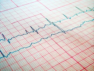 Healthy ECG on Graph Paper for Heart Disease Diagnosis - Medical Documented Insight