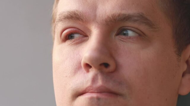Stye eye, barley eye,  chalazion eye, infection on eye on male face. 4k, high-quality video 