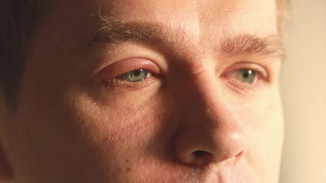 Stye eye, barley eye,  chalazion eye, infection on eye on male face. 4k, high-quality video 