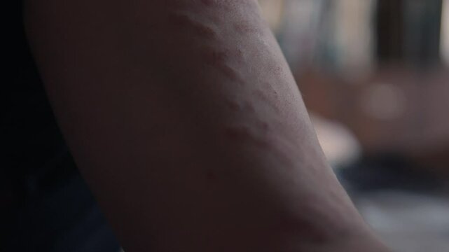 Damaged patient's skin after beauty procedures. Burns and scars. Red skin.