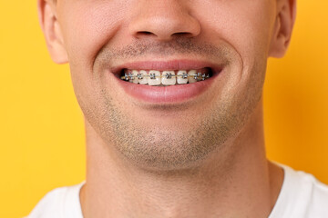 Obraz premium Smiling man with dental braces on yellow background, closeup