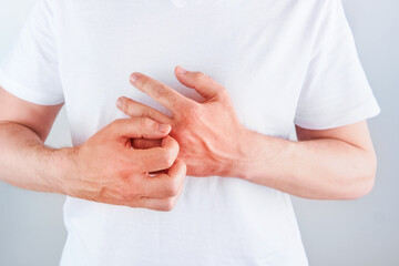 Man scratches or shows hands with dry, cracked skin on white backgrounds. Problem with many people...