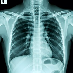 A close-up of a chest x-ray of a person's lungs