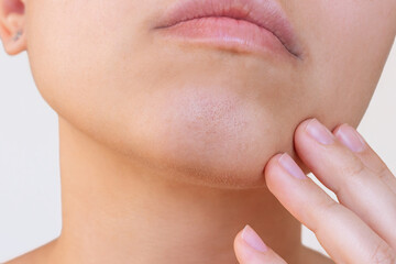 Young woman showing comedones on her chin touching with hands on white background. Pimples, acne,...