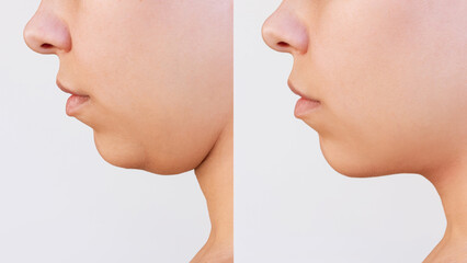 Liposuction of the double chin. Cropped shot of young woman's face with chin before and after cosmetic plastic surgery isolated on a white background. The result of lifting. Fat removal, weight loss