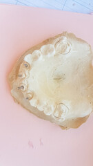 A patient's maxillary upper jaw cast model in dental plaster with removable prosthesis and metallic...