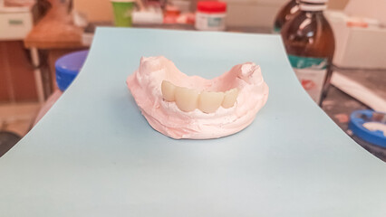 Upside-down maxillary cast model in dental plaster for a prosthesis case, edentulous molars and...