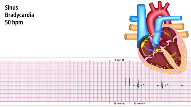 Sinus Bradycardia - ECG and Heart Conduction - Electrocardiogram Medical Animation
