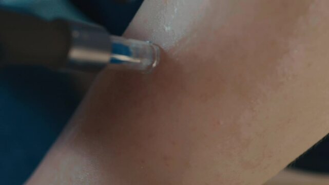 Cosmetologist's hands in black gloves using Meso Pen on patient's skin.