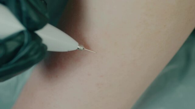 Cosmetologist's hands in black gloves using Laser Plasma Pen on patient's skin.