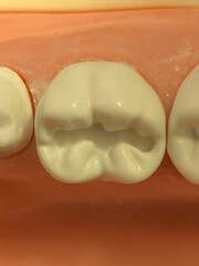 Class 1 cavity in a plastic mandibular molar