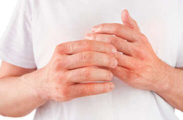 Man scratches or shows hands with dry, cracked skin on white backgrounds. Problem with many people - eczema on hand, allergies or dry skin. Health care concept. Close up.