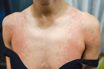 Fototapeta premium Skin health problem. Close-up woman's breast with allergy rash. 