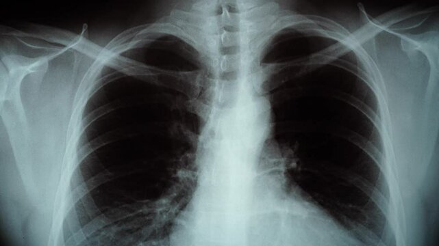 Vertical tracking of an x-ray of male lungs and chest.