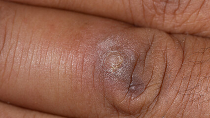 Epidermal wart on human skin, close-up showing infection and surface irregularity.