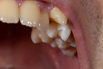 An intimate look at dental malocclusion with misaligned teeth, showcasing common dental issues that may require treatment.
