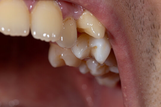 An intimate look at dental malocclusion with misaligned teeth, showcasing common dental issues that may require treatment.