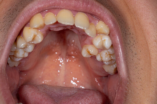 Detailed close-up of misaligned teeth in an open mouth, emphasizing the aesthetic and health implications of jaw malocclusion.