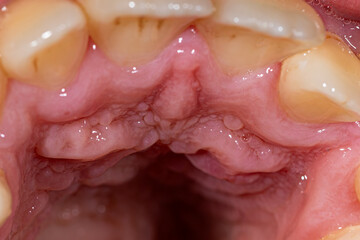 Obraz premium the upper palate's textures, including teeth alignment and oral details