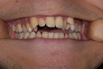 An open mouth view featuring crooked teeth and jaw malocclusion, emphasizing the importance of...