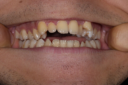 An open mouth view featuring crooked teeth and jaw malocclusion, emphasizing the importance of orthodontic treatment for dental irregularities
