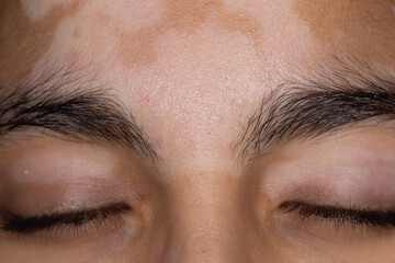 Close-up of Vitiligo Skin Condition on Forehead