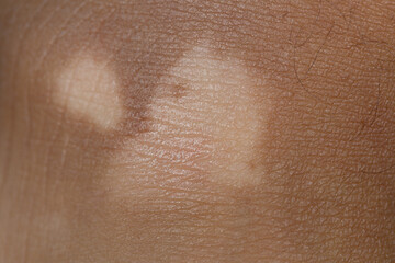Fototapeta premium Vitiligo Affecting Skin Pigmentation on a Foot