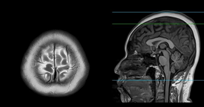 The MRI brain footage reveals areas of reduced blood flow, indicating early signs of stroke disease.