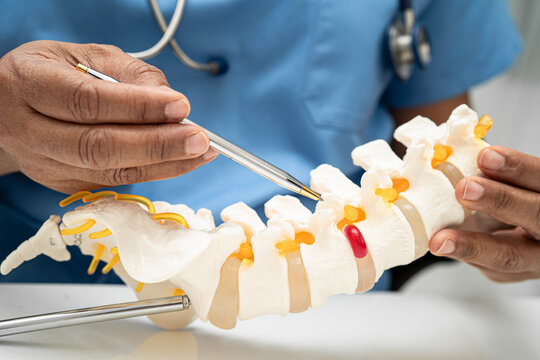 Asian doctor holding spinal nerve and bone model, Lumbar spine displaced herniated disc fragment for treatment medical in the orthopedic department.