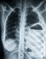 Chest xray of left sided Hydropneumothorax 