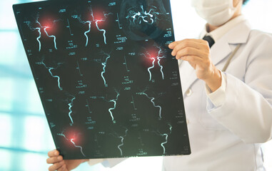 Doctor radiology looking stroke brain angiography x-ray image for diagnose ischemic stroke or aneurysm cerebrovascular disease.