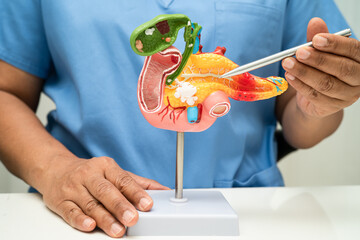 Pancreatitis, pancreatic cancer, Asian doctor with pancreas, gallbladder and bile duct human anatomy model at hospital.