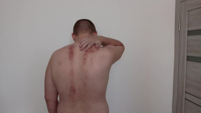 Redness and irritation on the skin of a man s back after a massage. Pimples and red spots with bruises on the skin, close-up, erythema