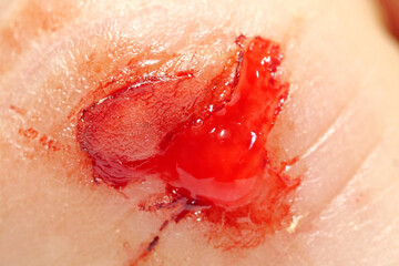 Injury of middle finger of right hand with bleeding. Flayed skin,blood and lymph