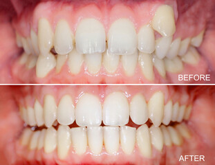 Before and after images showing orthodontic treatment results