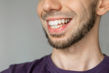Close-up of smiling man showing crooked teeth with beard