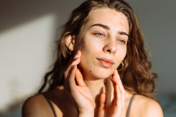 Portrait of a beautiful young woman with inflammations on the skin of her face.  Medicine and...