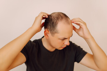 Baldness on the head of a middle-aged man. Hair loss. The concept of the problem of male hair loss,...