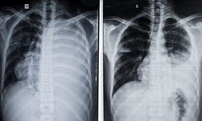 Chest X-Ray showing left sided massive pleural effusion with mediastinal shifting towards right before and after thoracentesis