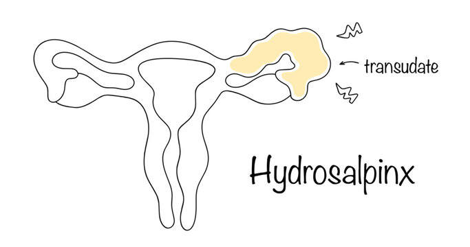 Hydrosalpinx