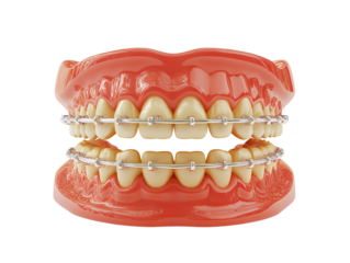 a model of teeth with braces