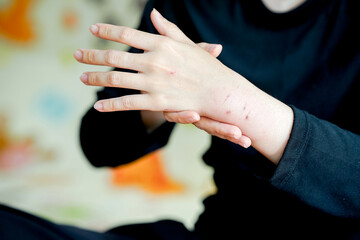 person gently rubs their hands, showing visible skin irritation and redness, possibly indicating...