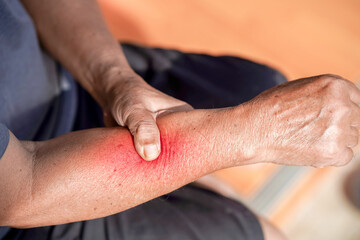 Fototapeta premium Person is holding their arm, which shows signs of irritation or injury, indicating discomfort. redness on skin suggests possible reaction or injury that may require attention