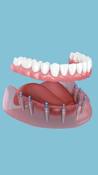 Mandibular prosthesis with gum All on 8 system supported by implants. 3D Animation