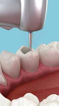 Endodontic root canal treatment process. Medically accurate tooth 3D animation