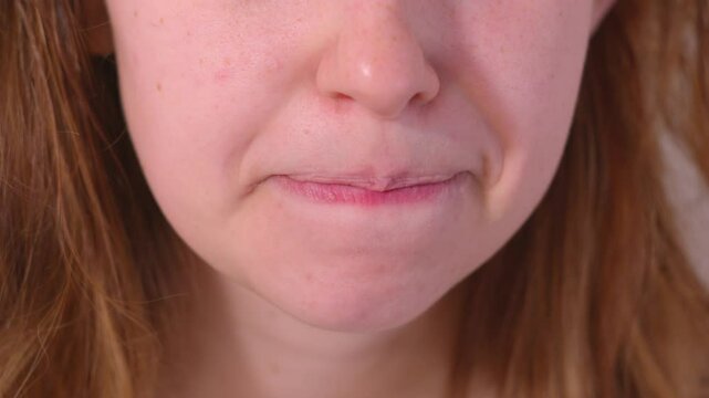 Close up shot of girl biting her dry and cracked lips due to fever. Static