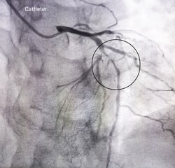 Coronary angiogram of left coronary artery during cardiac catheterization with contrast dye. Abnormal findings. Colour adjust.