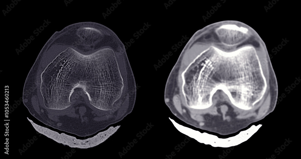 Poster a clear ct scan image of a healthy, normal knee joint, showcasing the bone structure and joint align
