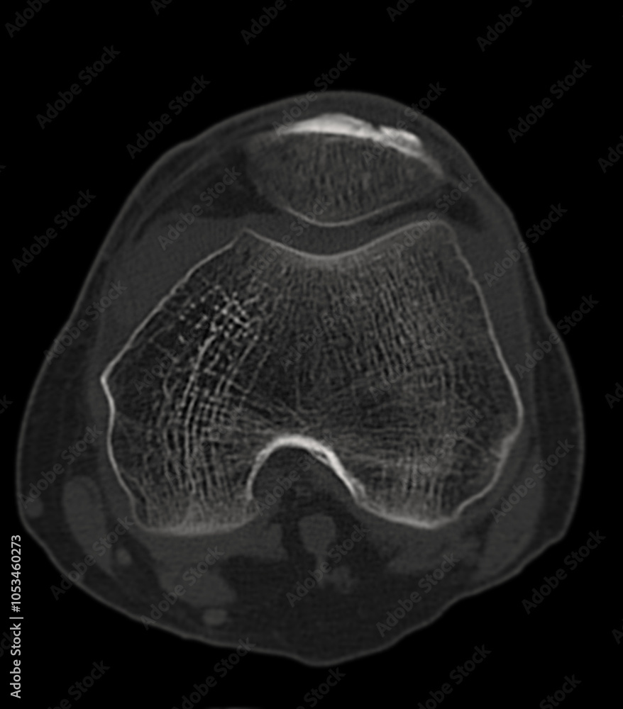 Poster a clear ct scan image of a healthy, normal knee joint, showcasing the bone structure and joint align