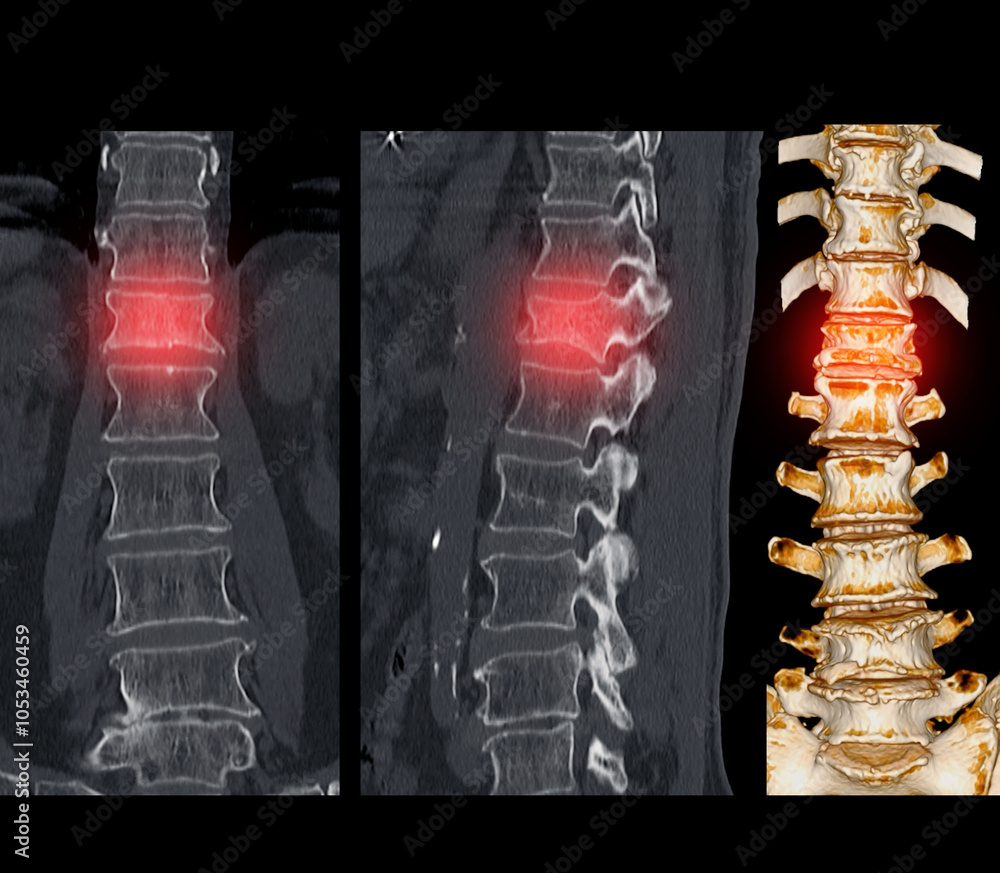 Poster lumbar spine ct imaging with l1 compression fracture.a vivid ct scan image highlighting a compressio